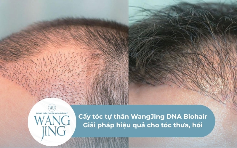 Cấy tóc tự thân WangJing DNA Biohair