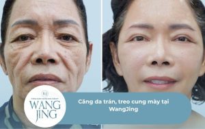 Căng da trán, treo cung mày