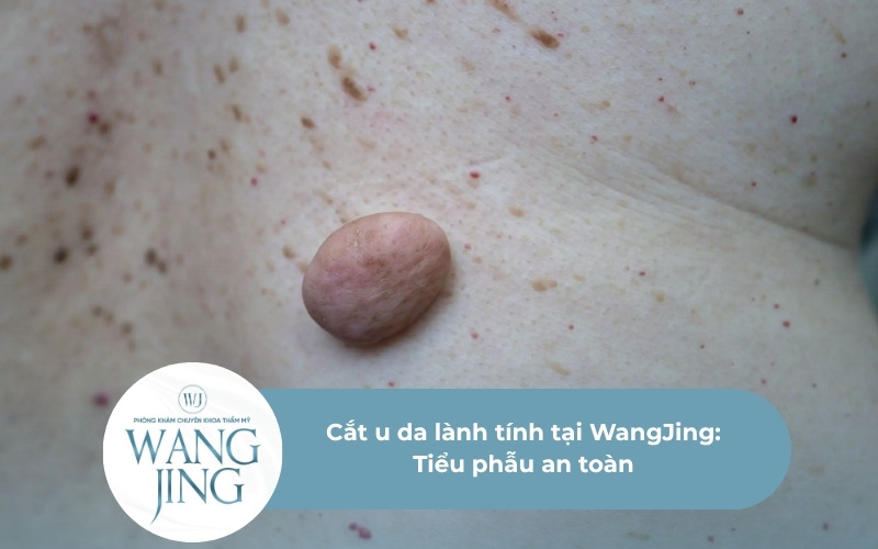 Cắt u da lành tính