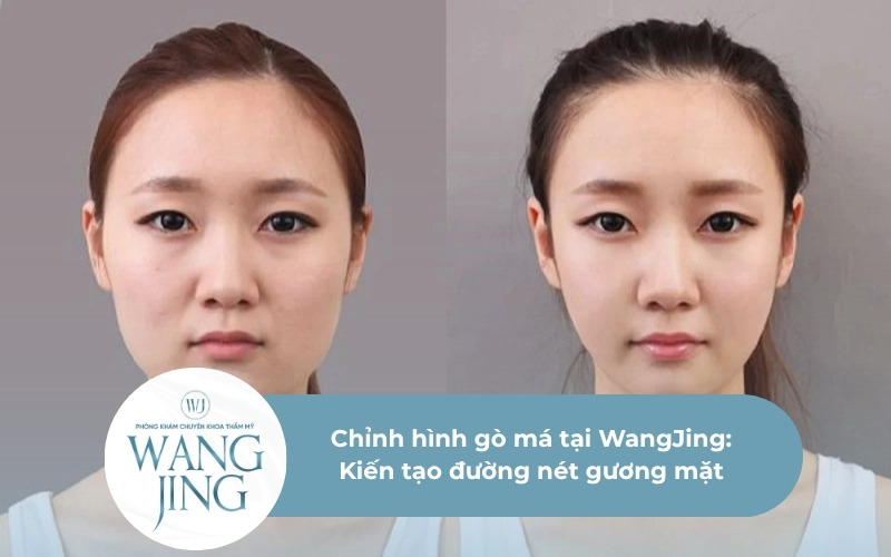 Chỉnh hình gò má