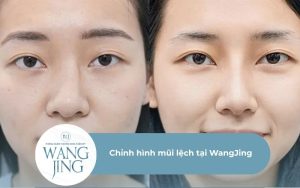 Chỉnh hình mũi lệch