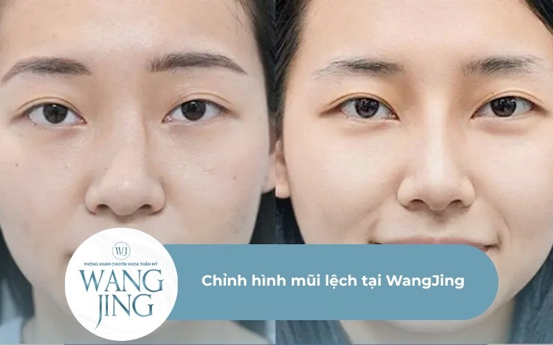 Chỉnh hình mũi lệch