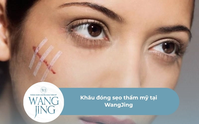 Khâu đóng sẹo thẩm mỹ