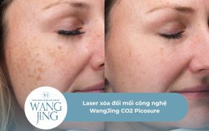 Laser xóa đồi mồi