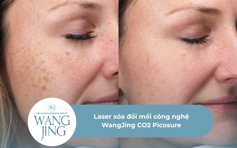 Laser xóa đồi mồi