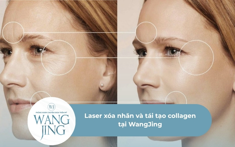 Laser xóa nhăn