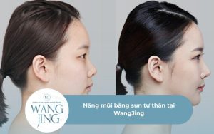 Nâng mũi bằng sụn tự thân