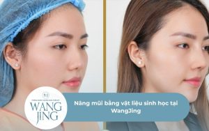 Nâng mũi bằng vật liệu sinh học