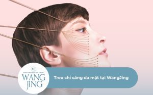 Treo chỉ căng da mặt