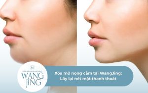 xóa mỡ nọng cằm