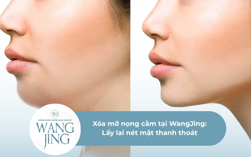 xóa mỡ nọng cằm