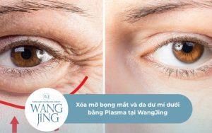 Xóa mỡ bọng mắt và da dư mí dưới