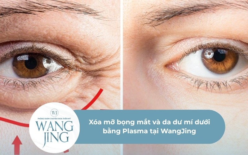 Xóa mỡ bọng mắt và da dư mí dưới