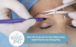 Xóa mỡ bọng mắt và da dư mí trên