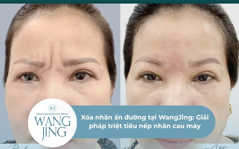 xóa nhăn ấn đường