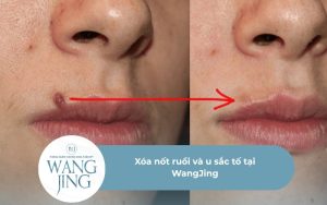 Xóa nốt ruồi