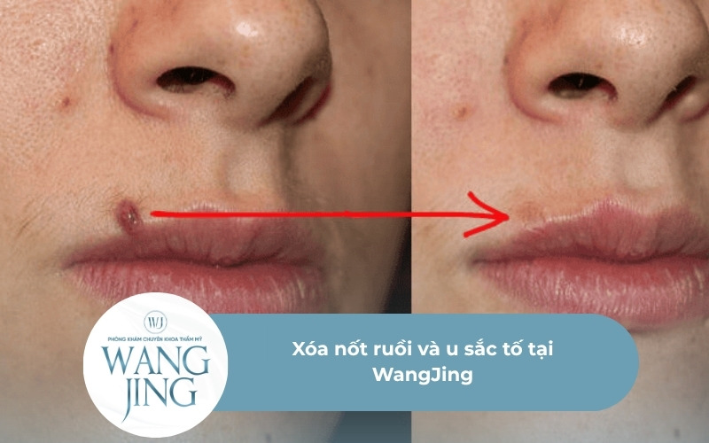 Xóa nốt ruồi